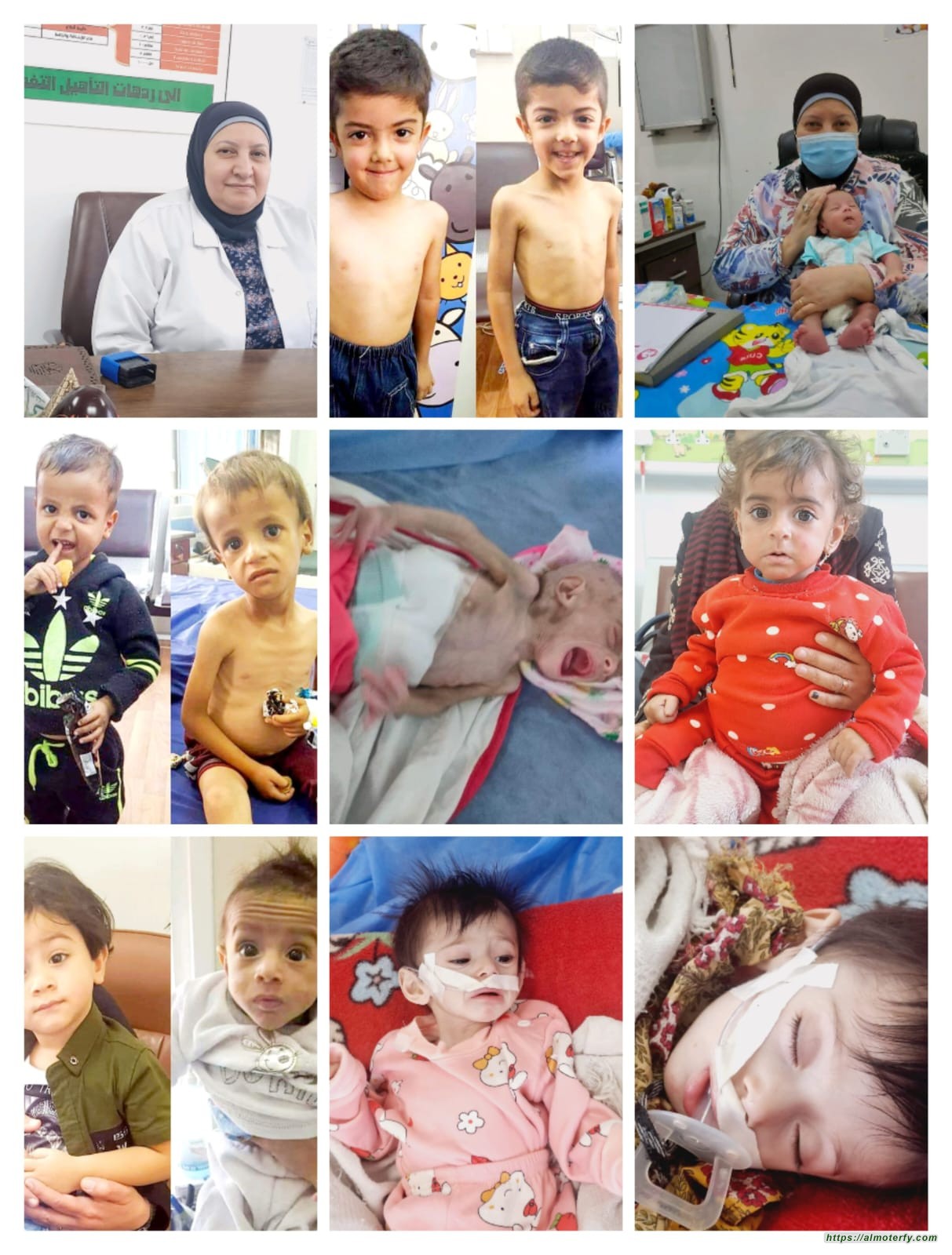 الاطفـال المصابين بسوء التغذيـة بين الحقيقة المفقودة والواقع المرير